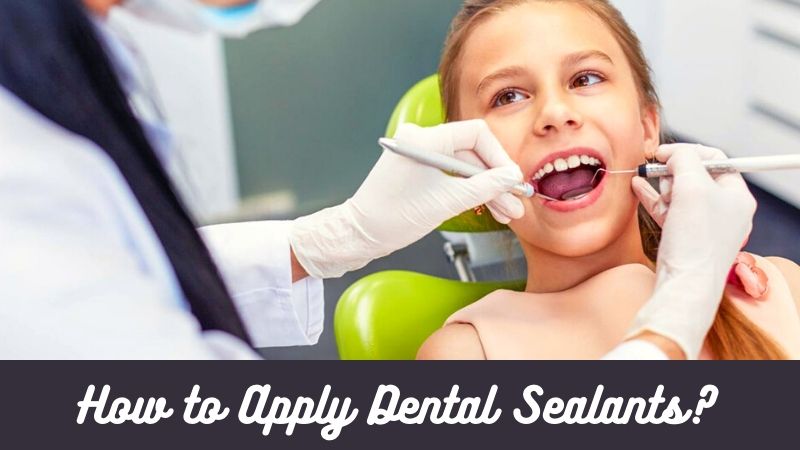 How to Apply Dental Sealants