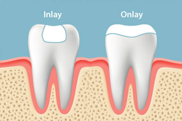 dental inlay vs onlay